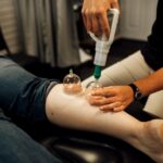 physical-therapy-clinic-cupping-dubuque-physical-therapy-Dubuque-IA